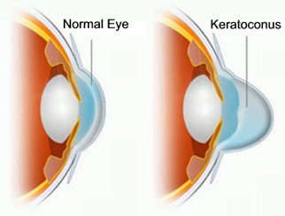 Cornea & Keratoconus