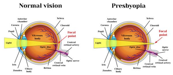 Presbyopia