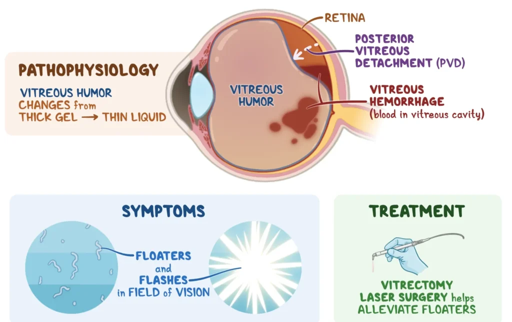 Changes in the Eye’s Retina