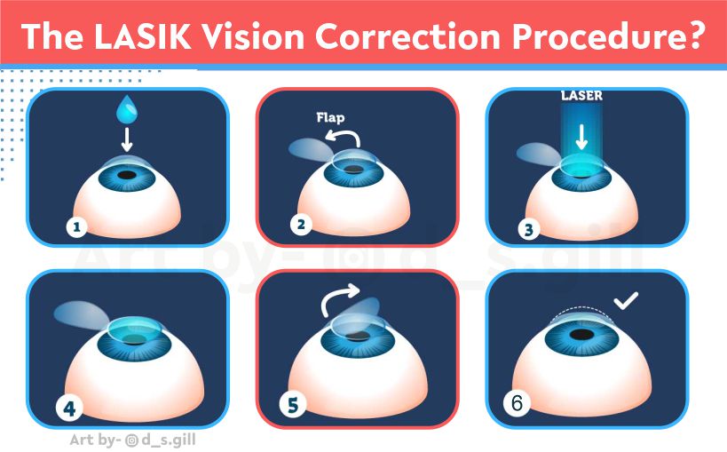 before and after lasik eye surgery
