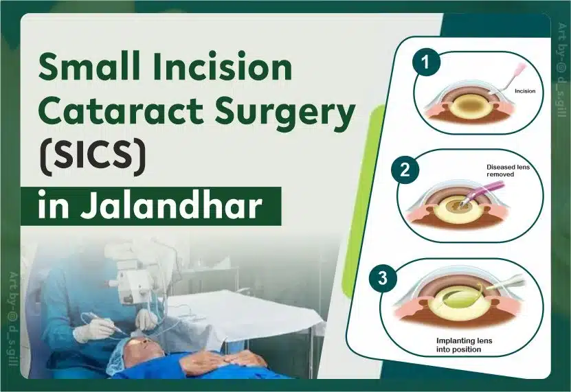 Small Incision Cataract Surgery (SICS)